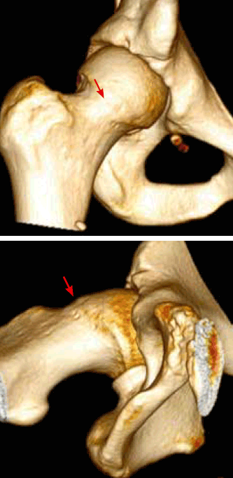 Figure 5. 3-Dimensional reconstructed CT images of cam-type deformity