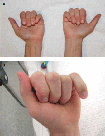 Figure 2. A) Normal hands. B) Malrotation of the fifth finger