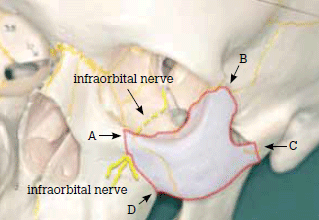 Figure 4. Zygomatic-orbital segment that is displaced in
cheek bone fractures (light blue)