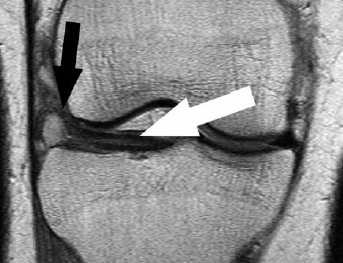 Figure 5. Coronal proton weighted MRI of horizontal 
tear of lateral meniscus (white arrow) with complicating ganglion (black arrow) at the lateral margin of the 
meniscus