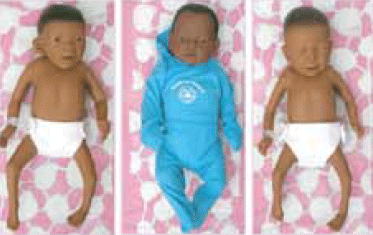 Figure 2. Educational dolls used within
the clinic: showing effects of fetal alcohol
syndrome (left), healthy doll (centre) and
showing effects of exposure to drugs in
the womb (right)4