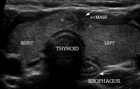 Figure 4. Thyroid ultrasound of a patient with an
impalpable nodule incidentally discovered on
ultrasound. Fine needle aspiration cytology of the lesion
revealed a papillary carcinoma
