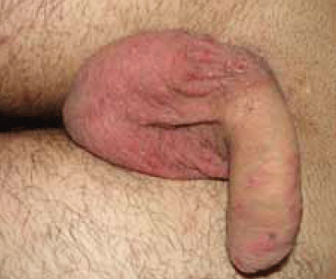 Figure 3. Erythematous nodules and
scratching lesions located on the
scrotum and penile shaft