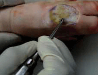 Figure 8. Curettage of sloughy wound