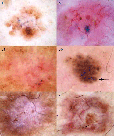 Figure 7. Clues to malignancy in nonmelanocytic pigmented malignancies
