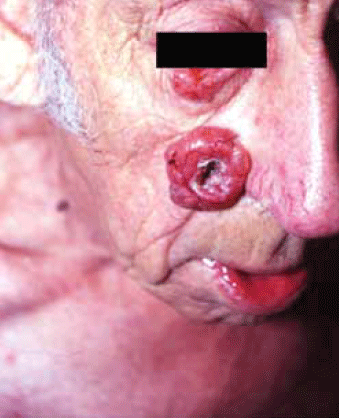 Figure 1. Very large nodular BCC with classic features