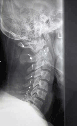 Figure 10. Lateral view of the patient's cervical spine