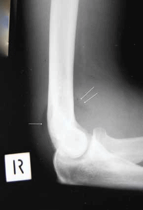 Figure 4. X-ray of the patient's elbow