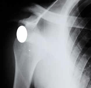 Figure 8. Shoulder X-ray in a different patient