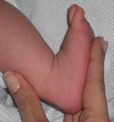 Figure 4. Postural clubfoot with normal passive range of motion