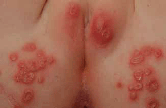 Figure 1. Clustered vesicles and uniformly small punched-out ulcers, herpes simplex