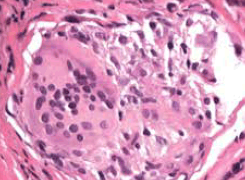 Figure 3. Haematoxylin & eosin stain of transbronchial lung biopsy showing a bronchial wall granuloma