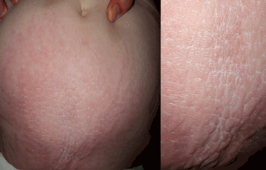 Figure 1. Area of skin on the lower abdomen with ill-defined, indurated, whitish papules