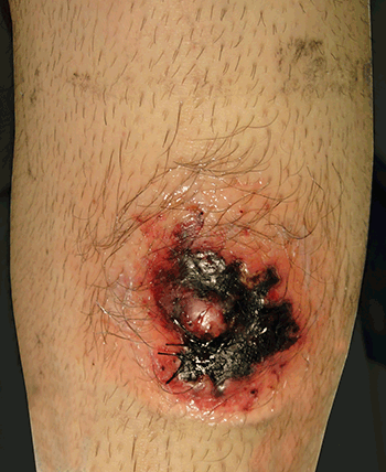 Figure 3. The lesion appears necrotic 3 days postbiopsy