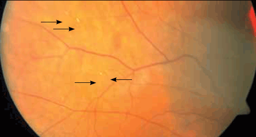 Figure 2. Right fundus image of retinal periphery, demonstrating
further multiple retinal emboli (marked by arrowheads)