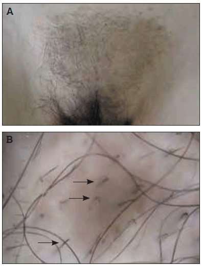 Figure 1a. An irregular patch of alopecia on the pubis with follicular hyperkeratosis and hyperpigmentation