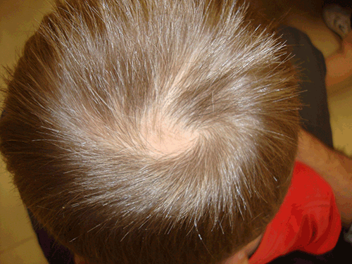 Figure 3. Patch alopecia in the occipital area in a male aged 7 years.