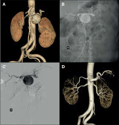Figure 3. Endovascular treatment of a splenic artery aneurysm with a covered stent