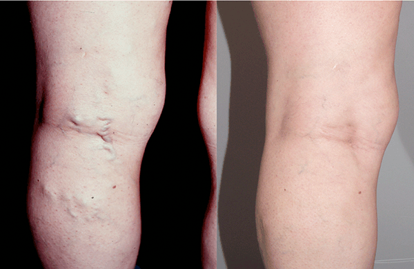 Figure 3. CEAP 2 veins