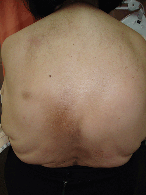 Figure 1. Brownish, ovoid patch of 5–7 cm in 
diameter on the skin over the lower margin 
of the patient’s left scapula