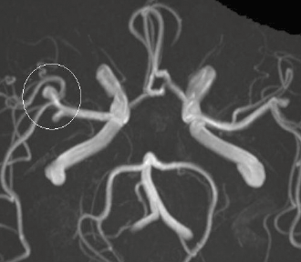Figure 5. Cerebral aneurysm