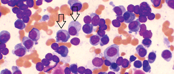 Figure 1A. Bone marrow aspirate showing increased numbers of plasma cells, including large and immature forms (arrows)