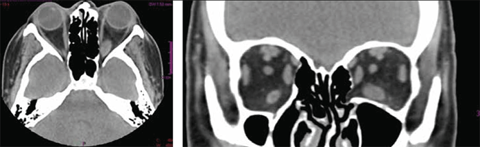 Figure 1. CT scan of the orbit revealing asymmetric bilateral opthalmopathy