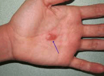 Figure 1. Palmar blister