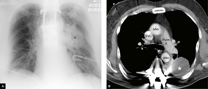 Booklet: Interstitial Pneumonia Chest X Ray Findings