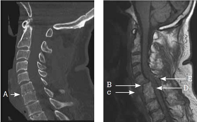 Figure 2. Missed injury on CT imaging in an alert patient
wearing a cervical collar
Sagittal CT image (left) of an alert male, 76 years of age,
front seat passenger in a low velocity motor vehicle accident.
Note the severe degenerative change at C6–C7
with almost complete loss of intervertebral disc height
(A). The CT was reported as negative for acute injury. On
removal of the collar, the patient subsequently reported
sudden and severe sensory and motor deficit. The sagittal
MRI image (right) indicates complete rupture of the C5–C6
intervertebral disc (B), and disruption of the anterior (C)
and posterior (D) longitudinal ligaments and ligamentum
flavum (E). Moderate/severe canal stenosis and minimal
cord oedema were reported at C6. There is posterior
epidural haematoma at C6–C7 and complete obliteration
of the C6–C7 intervertebral disc. Operative anterior fusion
was performed, and the patient regained satisfactory
sensory and motor function. This case emphasises the
importance of degenerative change on CT imaging as a
predictor of potential occult injury