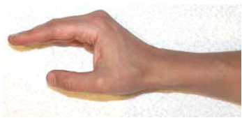 Figure 4. The safe position of the hand for splinting