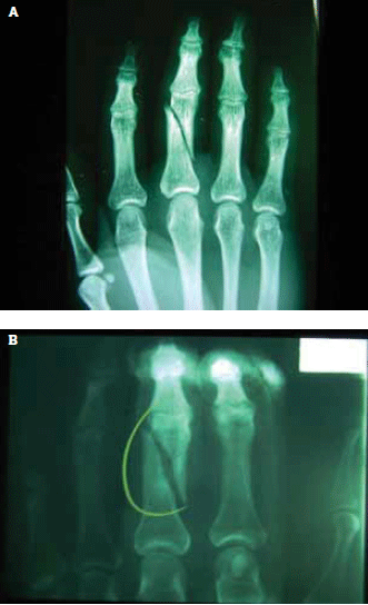 Figure 6. A) Fracture of middle phalanx fracture initially
and B) 1 week later showing further displacement