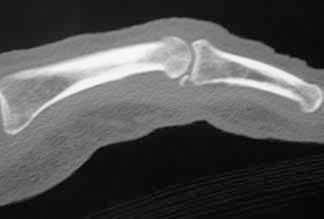 Figure 7. X-ray demonstrating a volar plate avulsion
fracture