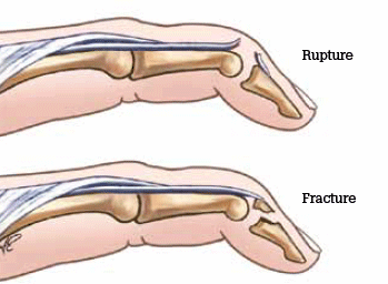Figure 8. Mallet finger deformity
Reproduced with permission: Brukner P, Khan K. Clinical
Sports Medicine. 3rd edn. Mc-Graw Hill, 2006