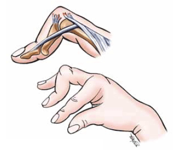 Figure 9. Boutonnière deformity
The rupture of the central slip of extensor digitorum from its
insertion allows the lateral bands to migrate in a palmar direction.
In turn, the middle phalanx is then pulled into flexion
by FDS; the PIP joint herniates through the central slip tear
Reproduced with permission: Brukner P, Khan K. Clinical
Sports Medicine. 3rd edn. Mc-Graw Hill, 2006