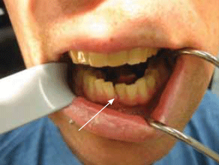 Figure 1. A step in the occlusal plane and ruptured
gingival (arrow) associated with a mandibular fracture