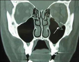 Figure 11. Coronal CT of a left orbital floor fracture
(arrow)