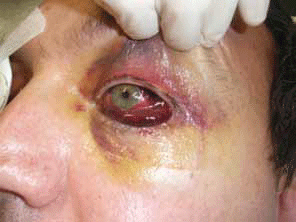 Figure 14. Early retrobulbar haematoma with loss of vision.