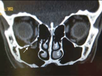 Figure 16. CT findings in a right sided white eye blowout
fracture with entrapment of orbital tissue (arrow)