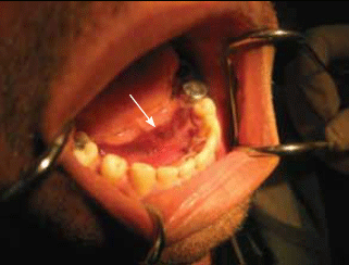 Figure 2. A sublingual haematoma (arrow) can be an
indicator of a mandibular fracture