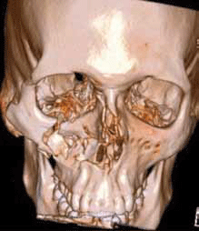 Figure 5. 3–D reconstruction of a right comminuted zygomatic complex fracture