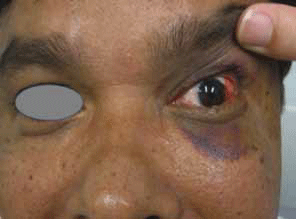 Figure 6. Left sided subconjunctival haematoma
and mild periorbital haematoma that might be
indicators for orbitozygomatic complex or orbital
wall fracture.