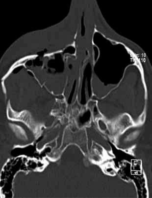Figure 7. Axial CT of a comminuted
zygomatic complex fracture