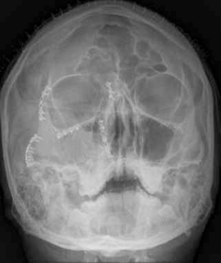 Figure 8. A zygomatic complex fracture treated with titanium miniplates and screws