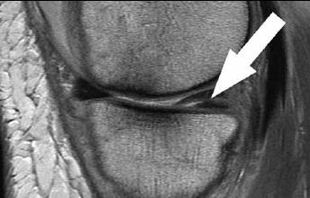 Figure 4. Proton weighted sagittal image demonstrates 
an example of a posterior horn medial meniscal horizontal tear (white arrow). The anterior horn of the medial meniscus demonstrates half of the normal anatomic 
'bow-tie configuration'. Note: the cartilage deficit more 
anteriorly on the medial femoral condyle and altered 
subchondral cortical bone interface
