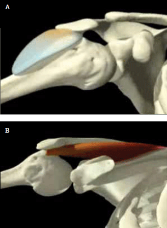 Figure 1. A) Impingement of the subacromial bursa 
between the humeral head and acromion; B) and 
supraspinatus between the humeral head, acromion and 
coraco-acromial ligament (not shown) 
Reproduced with permission Primal Pictures. 
Available at www.primalpictures.com