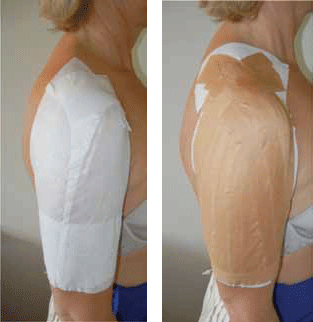 Figure 6. A) Application of hypoallergenic tape before 
application of strapping tape; B) For support of ACJ sprain. 
The strapping tape must be applied distal to proximal with 
significant traction to support and elevate the arm and 
therefore offload the ACJ