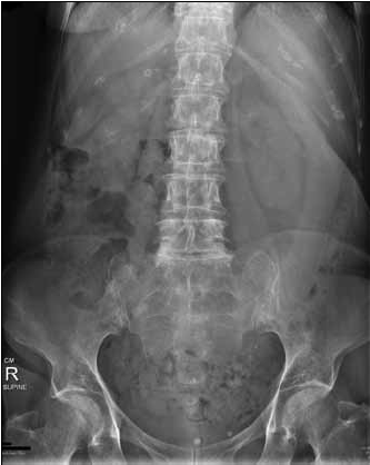 Figure 1. Plain X-ray of the patient's
abdomen