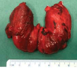 Figure 1. Macroscopic appearance of a
thyroid gland removed from a patient
with diffuse goitre secondary to Graves
disease