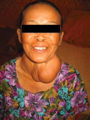 Figure 2. Woman from Northern
Thailand with endemic goitre secondary
to iodine deficiency